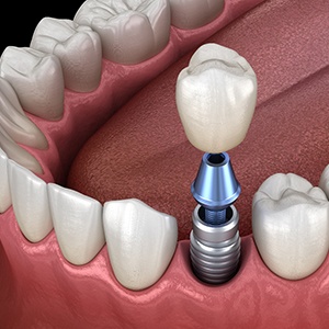 Dental implant in Jacksonville