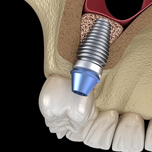 Dental implant in Jacksonville, FL placed after sinus lift