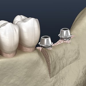 Two dental implants in Jacksonville, FL placed after ridge expansion