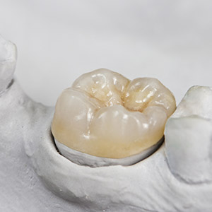 crown on top of plaster tooth