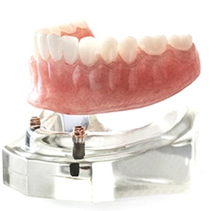 A mouth mold with two dental implants and a full lower denture in Jacksonville