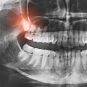 X-ray with problem wisdom teeth
