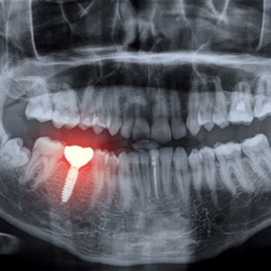 X-ray of dental implant failure in Jacksonville