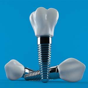 Dental implants in Jacksonville