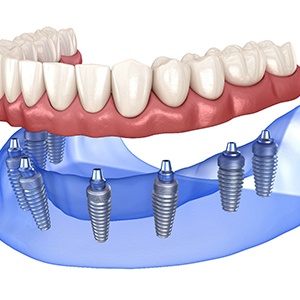 Implant dentures in Jacksonville