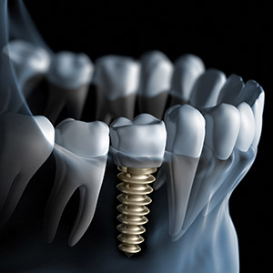 illustration of screwed in implant