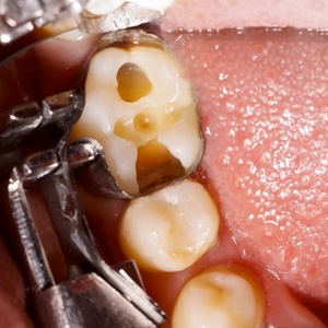 A damaged tooth before and after receiving a tooth-colored filling