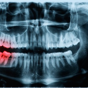 -ray of problematic wisdom tooth 