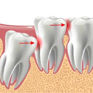 -illustration of problematic wisdom tooth  