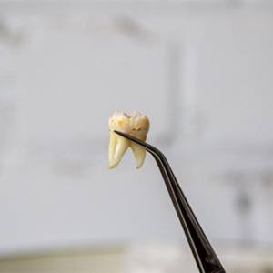 -forceps holding wisdom tooth 