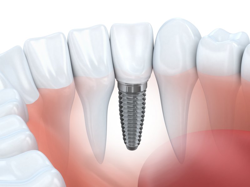 A diagram of dental implants in Jacksonville.