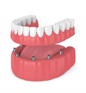 illustration of implant dentures 