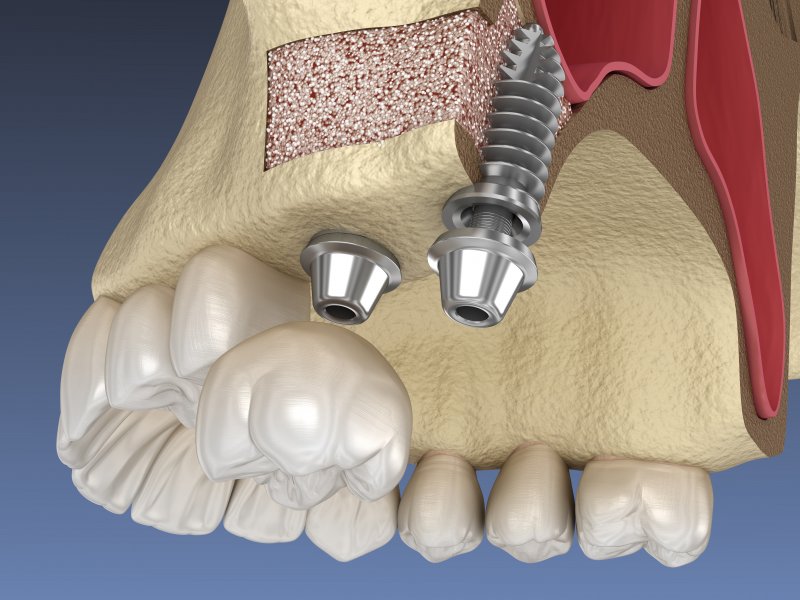 a dental implant after a sinus lift