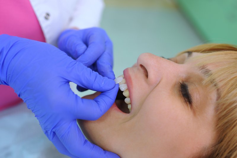A dentist placing veneers on a patient's teeth