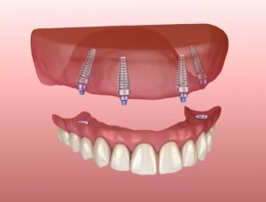 Model of implant-supported upper denture